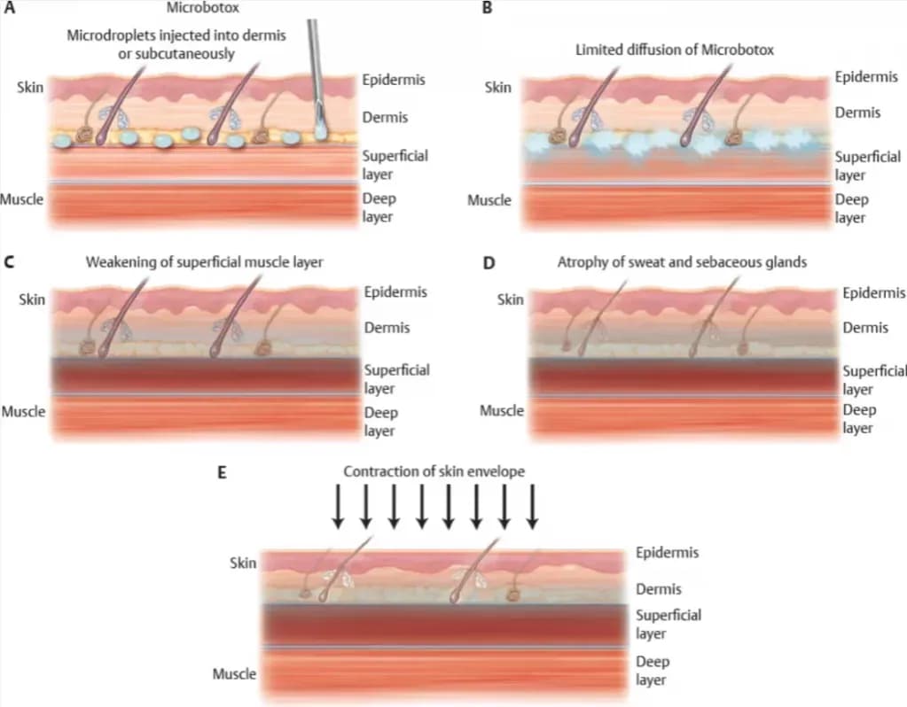 Jak działa botox? Poznaj mechanizm i skutki jego działania