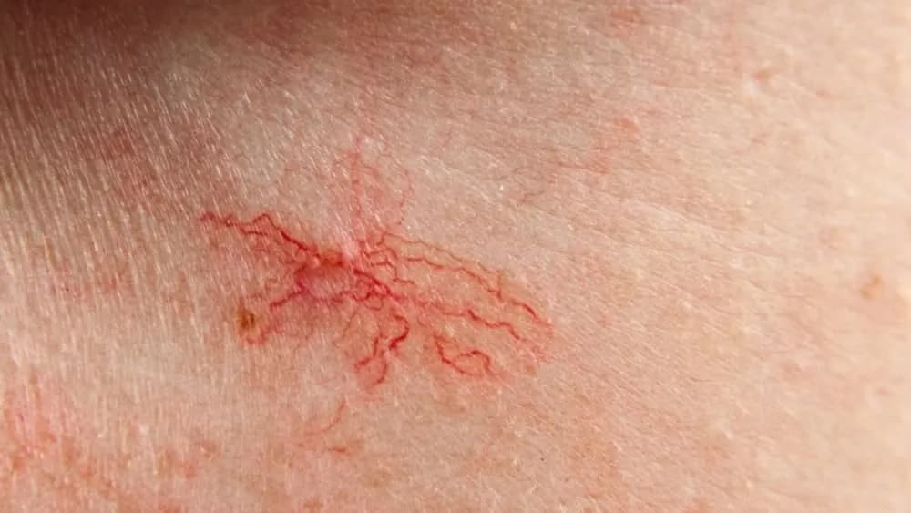 Jak wygląda cera naczynkowa? Objawy, cechy i skuteczne porady