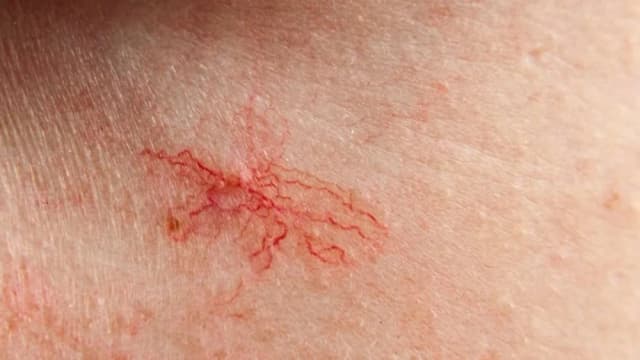 Jak wygląda cera naczynkowa? Objawy, cechy i skuteczne porady